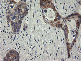 RIOK2 Antibody - IHC of paraffin-embedded Adenocarcinoma of Human colon tissue using anti-RIOK2 mouse monoclonal antibody.