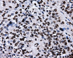 RIP1 / RALBP1 Antibody - IHC of paraffin-embedded Carcinoma of bladder tissue using anti-RALBP1 mouse monoclonal antibody. (Dilution 1:50).