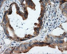 RIP1 / RALBP1 Antibody - Immunohistochemical staining of paraffin-embedded Adenocarcinoma of colon tissue using anti-RALBP1 mouse monoclonal antibody. (Dilution 1:50).