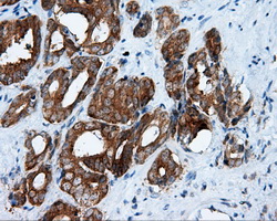 RIP1 / RALBP1 Antibody - Immunohistochemical staining of paraffin-embedded Carcinoma of prostate tissue using anti-RALBP1 mouse monoclonal antibody. (Dilution 1:50).