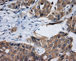 RIP1 / RALBP1 Antibody - IHC of paraffin-embedded Adenocarcinoma of breast tissue using anti-RALBP1 mouse monoclonal antibody. (Dilution 1:50).