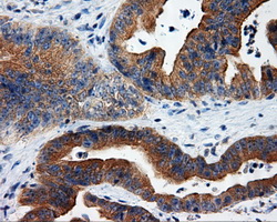 RIP1 / RALBP1 Antibody - IHC of paraffin-embedded Adenocarcinoma of colon tissue using anti-RALBP1 mouse monoclonal antibody. (Dilution 1:50).