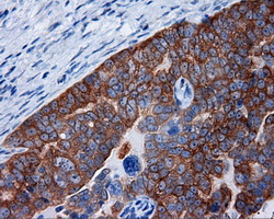 RIP1 / RALBP1 Antibody - IHC of paraffin-embedded Adenocarcinoma of ovary tissue using anti-RALBP1 mouse monoclonal antibody. (Dilution 1:50).