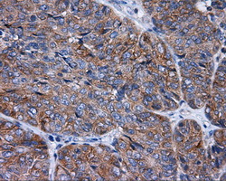 RIP1 / RALBP1 Antibody - IHC of paraffin-embedded Adenocarcinoma of endometrium tissue using anti-RALBP1 mouse monoclonal antibody. (Dilution 1:50).