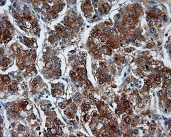 RIP1 / RALBP1 Antibody - IHC of paraffin-embedded Carcinoma of liver tissue using anti-RALBP1 mouse monoclonal antibody. (Dilution 1:50).