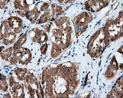 RIP1 / RALBP1 Antibody - IHC of paraffin-embedded Carcinoma of prostate tissue using anti-RALBP1 mouse monoclonal antibody. (Dilution 1:50).
