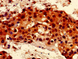 RIP1 / RALBP1 Antibody - Immunohistochemistry of paraffin-embedded human breast cancer at dilution of 1:100