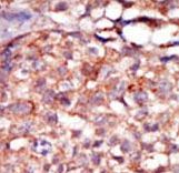 RIP4 / ANKRD3 Antibody - Formalin-fixed and paraffin-embedded human cancer tissue reacted with the primary antibody, which was peroxidase-conjugated to the secondary antibody, followed by AEC staining. This data demonstrates the use of this antibody for immunohistochemistry; clinical relevance has not been evaluated. BC = breast carcinoma; HC = hepatocarcinoma.