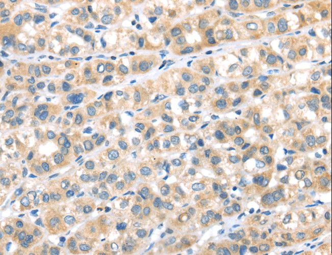 RIP4 / ANKRD3 Antibody - Immunohistochemistry of paraffin-embedded Human esophagus cancer using RIPK4 Polyclonal Antibody at dilution of 1:40.