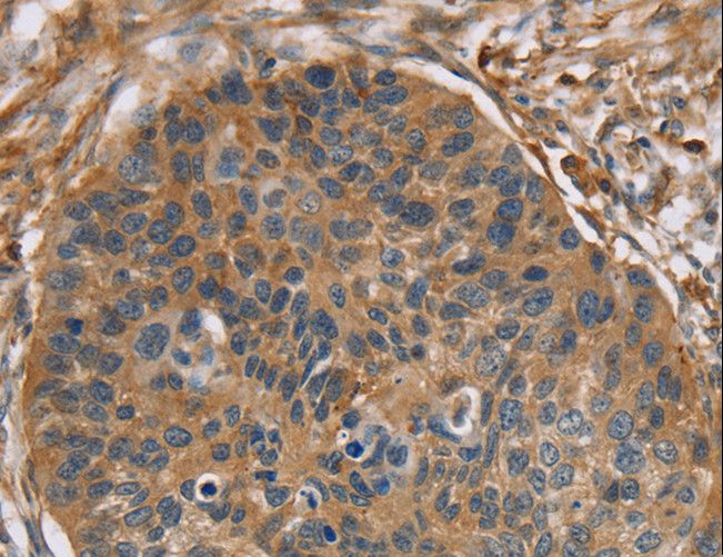 RIP4 / ANKRD3 Antibody - Immunohistochemistry of paraffin-embedded Human breast cancer using RIPK4 Polyclonal Antibody at dilution of 1:40.