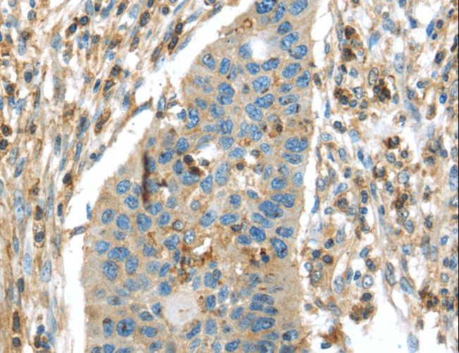 RIP4 / ANKRD3 Antibody - Immunohistochemistry of paraffin-embedded Human breast cancer using RIPK4 Polyclonal Antibody at dilution of 1:40.
