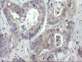 RIPK1 / RIP Antibody - IHC of paraffin-embedded Adenocarcinoma of Human colon tissue using anti-RIPK1 mouse monoclonal antibody.