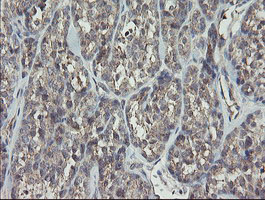 RIPK1 / RIP Antibody - IHC of paraffin-embedded Carcinoma of Human thyroid tissue using anti-RIPK1 mouse monoclonal antibody.