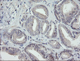 RIPK1 / RIP Antibody - IHC of paraffin-embedded Carcinoma of Human prostate tissue using anti-RIPK1 mouse monoclonal antibody.