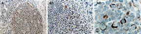 RIPK1 / RIP Antibody - IHC of RIP in formalin-fixed, paraffin-embedded normal human tonsil using RIPK1 / RIP Antibody at 1:2000. A, low magnification over view of a secondary follicle. A1 and A2, successively higher magnifications of the germinal center from A. Hematoxylin-Eos in counterstain.
