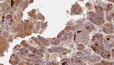 RIPK1 / RIP Antibody - 1:100 staining human liver carcinoma tissues by IHC-P. The sample was formaldehyde fixed and a heat mediated antigen retrieval step in citrate buffer was performed. The sample was then blocked and incubated with the antibody for 1.5 hours at 22°C. An HRP conjugated goat anti-rabbit antibody was used as the secondary.