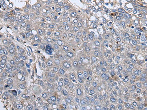 RIPK1 / RIP Antibody - Immunohistochemistry of paraffin-embedded Human liver cancer tissue  using RIPK1 Polyclonal Antibody at dilution of 1:85(×200)