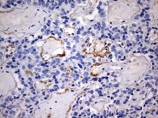 RIPK3 / RIP3 Antibody - IHC of paraffin-embedded Carcinoma of Human pancreas tissue using anti-RIPK3 mouse monoclonal antibody. (Heat-induced epitope retrieval by 1 mM EDTA in 10mM Tris, pH9.0, 120°C for 3min).