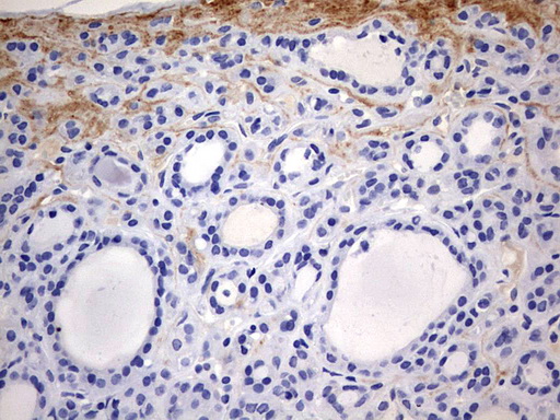RIPK3 / RIP3 Antibody - IHC of paraffin-embedded Carcinoma of Human thyroid tissue using anti-RIPK3 mouse monoclonal antibody. (Heat-induced epitope retrieval by 1 mM EDTA in 10mM Tris, pH9.0, 120°C for 3min).