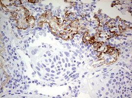 RIPK3 / RIP3 Antibody - IHC of paraffin-embedded Carcinoma of Human lung tissue using anti-RIPK3 mouse monoclonal antibody. (Heat-induced epitope retrieval by 10mM citric buffer, pH6.0, 120°C for 3min).