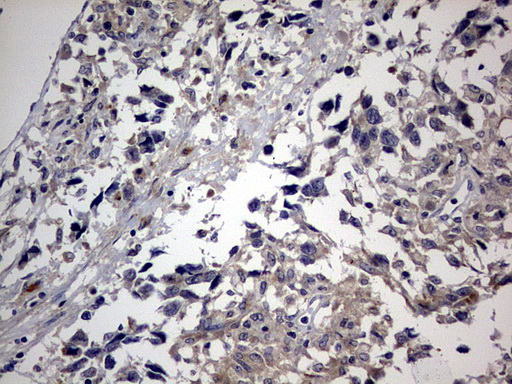 RIPK3 / RIP3 Antibody - IHC of paraffin-embedded Adenocarcinoma of Human ovary tissue using anti-RIPK3 mouse monoclonal antibody. (Heat-induced epitope retrieval by 10mM citric buffer, pH6.0, 120°C for 3min).