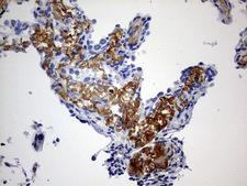 RIPK3 / RIP3 Antibody - IHC of paraffin-embedded Carcinoma of Human lung tissue using anti-RIPK3 mouse monoclonal antibody. (Heat-induced epitope retrieval by 10mM citric buffer, pH6.0, 120°C for 3min).