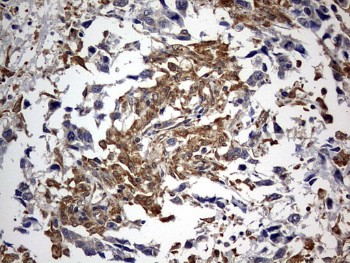 RIPK3 / RIP3 Antibody - IHC of paraffin-embedded Adenocarcinoma of Human ovary tissue using anti-RIPK3 mouse monoclonal antibody. (Heat-induced epitope retrieval by 10mM citric buffer, pH6.0, 120°C for 3min).