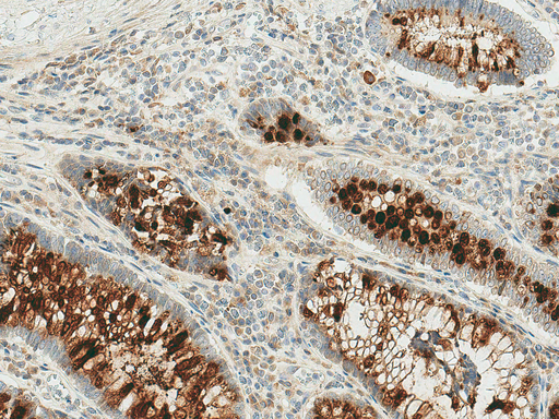 RIPK3 / RIP3 Antibody - Immunohistochemistry analysis using Rabbit Anti-RIP3 Polyclonal Antibody. Tissue: Colon Cancer. Species: Human. Fixation: Formalin Fixed Paraffin-Embedded. Primary Antibody: Rabbit Anti-RIP3 Polyclonal Antibody  at 1:50 for 30 min at RT. Counterstain: Hematoxylin. Magnification: 10X. HRP-DAB Detection.