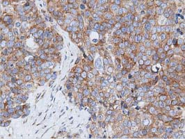 RIT2 / RIN Antibody - Immunohistochemical staining of paraffin-embedded Adenocarcinoma of Human ovary tissue using anti-RIT2 mouse monoclonal antibody. (Dilution 1:50).
