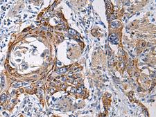 RITA1 / C12orf52 Antibody - Immunohistochemistry of paraffin-embedded Human esophagus cancer tissue  using RITA1 Polyclonal Antibody at dilution of 1:60(×200)