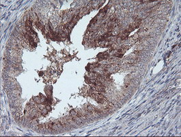 RLBP1 / CRALBP Antibody - IHC of paraffin-embedded Adenocarcinoma of Human endometrium tissue using anti-RLBP1 mouse monoclonal antibody.