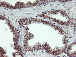 RLBP1 / CRALBP Antibody - IHC of paraffin-embedded Carcinoma of Human prostate tissue using anti-RLBP1 mouse monoclonal antibody.