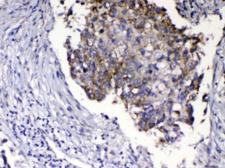 RLN1 / Relaxin Antibody - IHC testing of FFPE human lung cancer tissue with Relaxin antibody at 1ug/ml. Required HIER: steam section in pH6 citrate buffer for 20 min and allow to cool prior to testing.