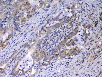 RLN1 / Relaxin Antibody - IHC testing of FFPE human colon cancer tissue with Relaxin antibody at 1ug/ml. Required HIER: steam section in pH6 citrate buffer for 20 min and allow to cool prior to testing.