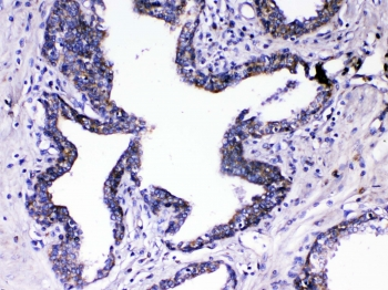 RLN1 / Relaxin Antibody - IHC testing of FFPE human prostate cancer tissue with Relaxin antibody at 1ug/ml. Required HIER: steam section in pH6 citrate buffer for 20 min and allow to cool prior to testing.