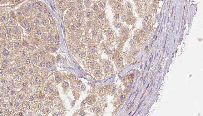 RLN2 / Relaxin 2 Antibody - 1:100 staining human Melanoma tissue by IHC-P. The sample was formaldehyde fixed and a heat mediated antigen retrieval step in citrate buffer was performed. The sample was then blocked and incubated with the antibody for 1.5 hours at 22°C. An HRP conjugated goat anti-rabbit antibody was used as the secondary.