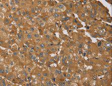 RMA1 / RNF5 Antibody - Immunohistochemistry of paraffin-embedded Human liver cancer using RNF5 Polyclonal Antibody at dilution of 1:35.
