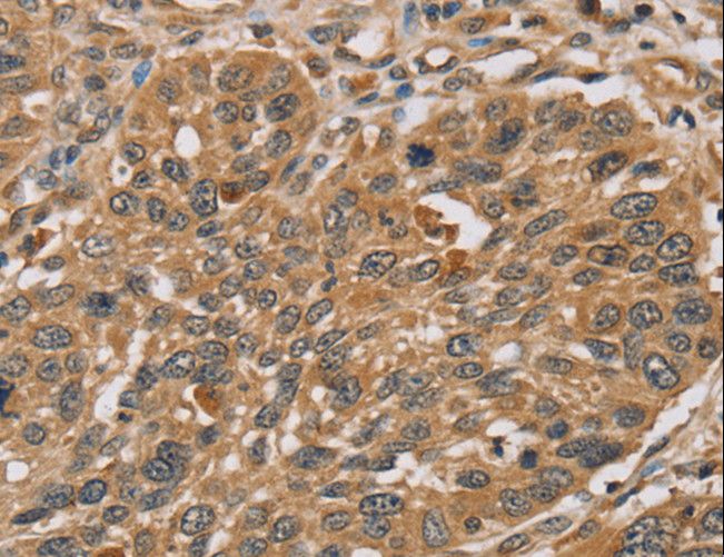 RMA1 / RNF5 Antibody - Immunohistochemistry of paraffin-embedded Human lung cancer using RNF5 Polyclonal Antibody at dilution of 1:35.