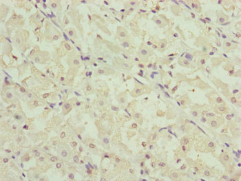 RMA1 / RNF5 Antibody - Immunohistochemistry of paraffin-embedded human gastric cancer at dilution of 1:100