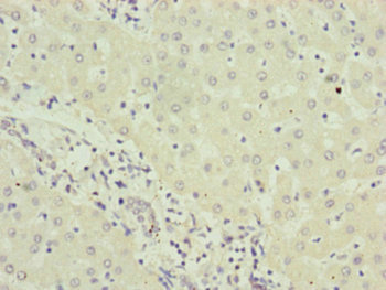 RMA1 / RNF5 Antibody - Immunohistochemistry of paraffin-embedded human liver cancer at dilution of 1:100