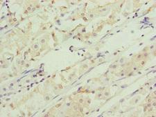 RMA1 / RNF5 Antibody - Immunohistochemistry of paraffin-embedded human gastric cancer at dilution of 1:100
