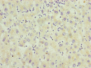 RMA1 / RNF5 Antibody - Immunohistochemistry of paraffin-embedded human liver cancer at dilution of 1:100