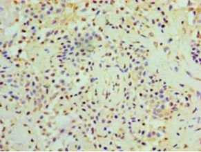 RMDN3 Antibody - Immunohistochemistry of paraffin-embedded human breast cancer using antibody at 1:100 dilution.  This image was taken for the unconjugated form of this product. Other forms have not been tested.