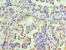 RMDN3 Antibody - Immunohistochemistry of paraffin-embedded human lung cancer using antibody at 1:100 dilution.  This image was taken for the unconjugated form of this product. Other forms have not been tested.