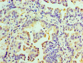 RMDN3 Antibody - Immunohistochemistry of paraffin-embedded human lung cancer using RMDN3 Antibody at dilution of 1:100