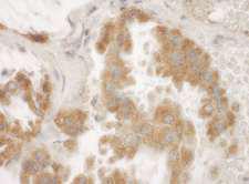 RMDN3 Antibody - Detection of Human PTPIP51 by Immunohistochemistry. Sample: FFPE section of human lung carcinoma. Antibody: Affinity purified rabbit anti-PTPIP51 used at a dilution of 1:1000 (1 ug/mg).