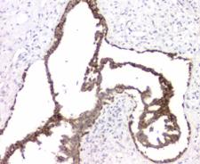 RMI2 / C16orf75 Antibody - IHC staining of FFPE human breast cancer with RMI2 antibody at 1ug/ml. HIER: boil tissue sections in pH6, 10mM citrate buffer, for 10-20 min and allow to cool before testing.
