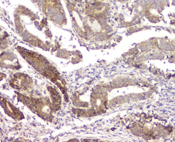 RMI2 / C16orf75 Antibody - IHC staining of FFPE human intestinal cancer with RMI2 antibody at 1ug/ml. HIER: boil tissue sections in pH6, 10mM citrate buffer, for 10-20 min and allow to cool before testing.