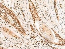 RMND5B Antibody - Immunohistochemistry of paraffin-embedded Human esophagus cancer tissue  using RMND5B Polyclonal Antibody at dilution of 1:50(×200)