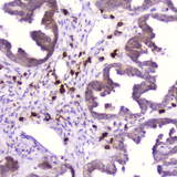 RNASE3 Antibody - IHC analysis of Ribonuclease 3 using anti-Ribonuclease 3 antibody. Ribonuclease 3 was detected in paraffin-embedded section of human ovary cancer tissue. Heat mediated antigen retrieval was performed in citrate buffer (pH6, epitope retrieval solution) for 20 mins. The tissue section was blocked with 10% goat serum. The tissue section was then incubated with 2?g/ml rabbit anti-Ribonuclease 3 Antibody overnight at 4?C. Biotinylated goat anti-rabbit IgG was used as secondary antibody and incubated for 30 minutes at 37?C. The tissue section was developed using Strepavidin-Biotin-Complex (SABC) with DAB as the chromogen.